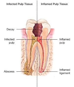 Root Canal Dentist Yorketown NJ